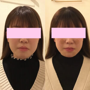 福岡で小顔整体を受けた様子