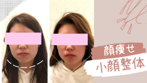 福岡で小顔整体をした後の様子