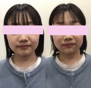 20代女性が小顔整体を受けた様子
